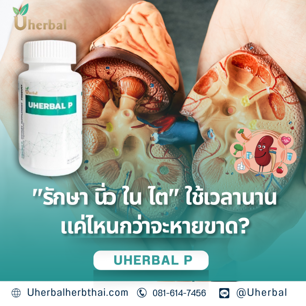 "รักษา นิ่ว ใน ไต" ใช้เวลานานแค่ไหนกว่าจะหายขาด?