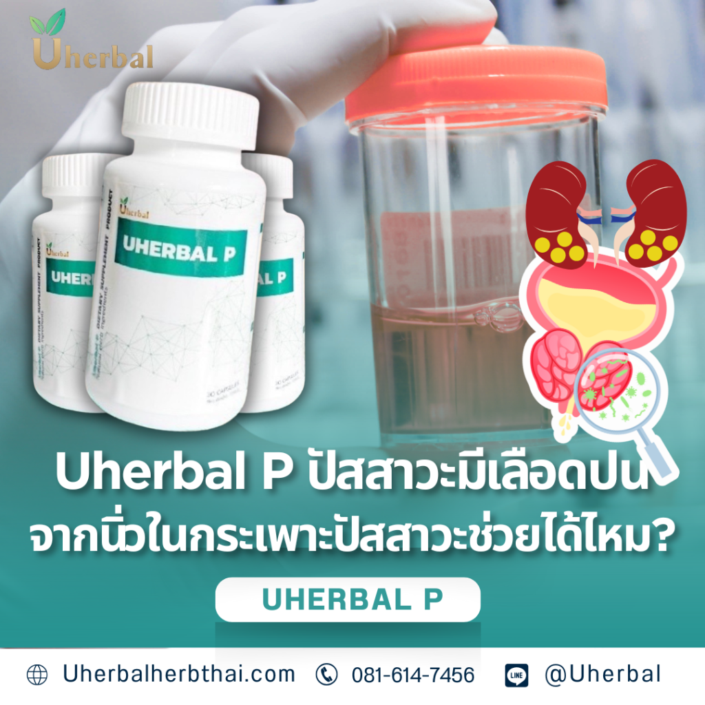Uherbal P ปัสสาวะมีเลือดปนจากนิ่วในกระเพาะปัสสาวะช่วยได้ไหม?